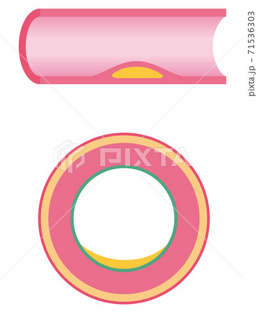 血管閉塞 動脈硬化の進行 血管閉塞 動脈硬化の進行 71536303