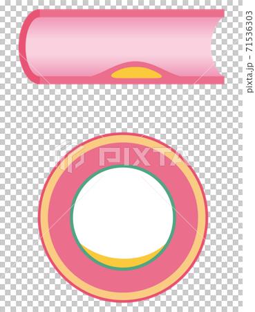 血管閉塞 動脈硬化の進行 血管閉塞 動脈硬化の進行 71536303