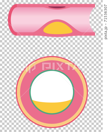 血管閉塞 動脈硬化の進行 血管閉塞 動脈硬化の進行 71536307