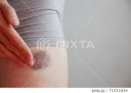 Man applies the healing gel to the bruise. Bruise on leg Man applies the healing gel to the bruise. Bruise on leg 71551834