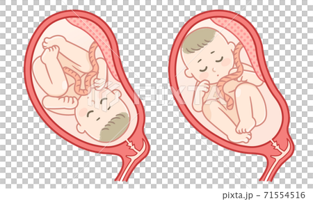 胎児(頭位と逆子)のイラスト 胎児(頭位と逆子)のイラスト 71554516