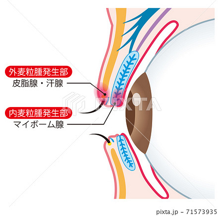 瞼の構造　麦粒腫　断面 71573935