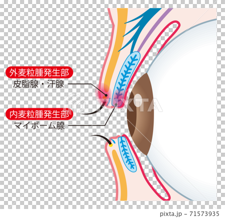 瞼の構造　麦粒腫　断面 71573935