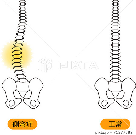 メディカル 姿勢 側弯症 骨 上半身 背面のイラスト素材 メディカル 姿勢 側弯症 骨 上半身 背面のイラスト素材