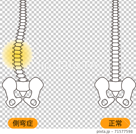 Medical posture (scoliosis) Bone upper body back 71577598