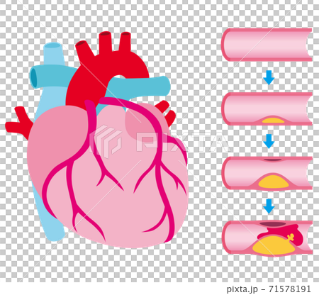 動脈硬化的血管阻塞進展 71578191