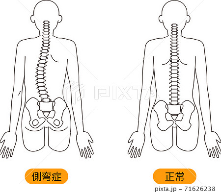 メディカル 姿勢 側弯症 上半身 背面のイラスト素材