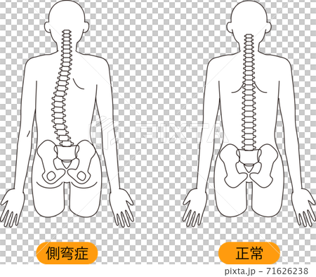 メディカル 姿勢 側弯症 上半身 背面のイラスト素材