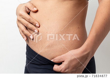 Stretch Marks, Women Show off the belly after birth on white background Stretch Marks, Women Show off the belly after birth on white background 71634877