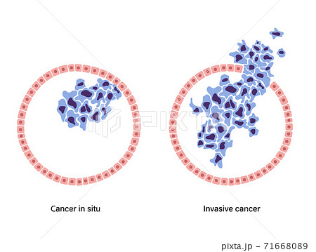 Breast disease concept 71668089
