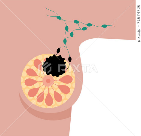 Breast disease concept Breast disease concept 71674736
