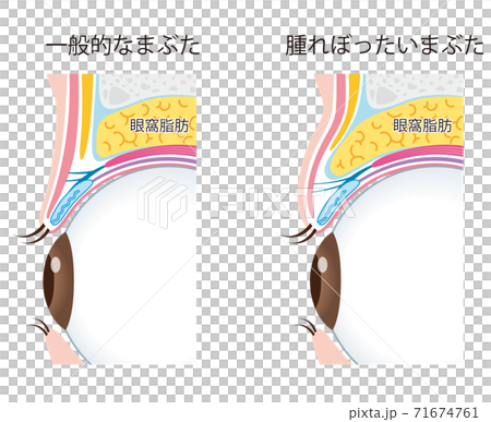 眼瞼腫脹眼瞼結構 眼瞼腫脹眼瞼結構 71674761