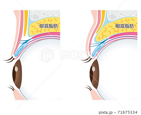 腫れぼったいまぶた 瞼の構造のイラスト素材