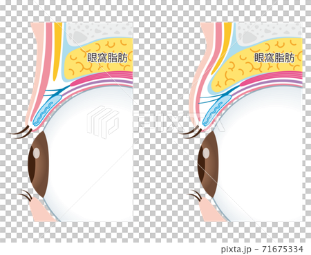 Swollen eyelid structure 71675334