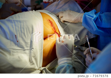 Surgery. View of the hands of the surgeon stitching up the wound. Surgery. View of the hands of the surgeon stitching up the wound. 71679378