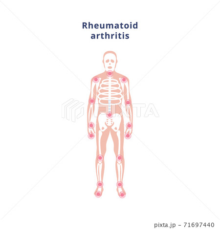 Poster with human skeleton with sources of pain disease rheumatoid arthritis Poster with human skeleton with sources of pain disease rheumatoid arthritis 71697440