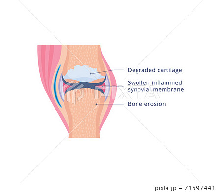 Diagram of knee joint with osteoarthritis, flat vector illustration isolated. Diagram of knee joint with osteoarthritis, flat vector illustration isolated. 71697441