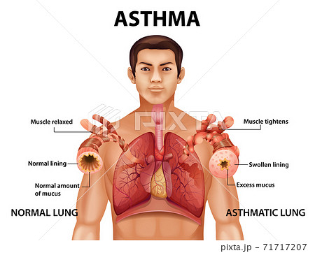 Comparison of healthy lung and Asthmatic lung 71717207