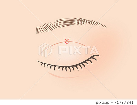 二重手術のイラスト（埋没法・1点留め） 71737841