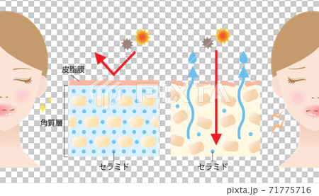 セラミド　乾燥肌　断面図　女性　ビフォアアフター 71775716