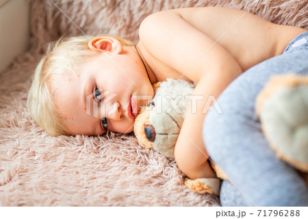 Little baby boy with Varicella virus or Chickenpox bubble rash. 71796288