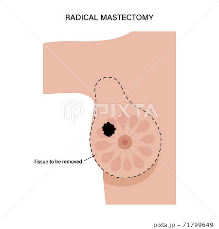 Breast disease concept Breast disease concept 71799649