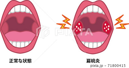 Illustration Of Tonsillitis Stock Illustration Illustration Of Tonsillitis Stock Illustration