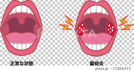 Illustration of tonsillitis 71800415
