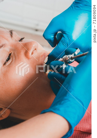 Local anesthesia, the dentist uses a carpal syringe, introducing local anesthesia into the gums. Local anesthesia, the dentist uses a carpal syringe, introducing local anesthesia into the gums. 71809094