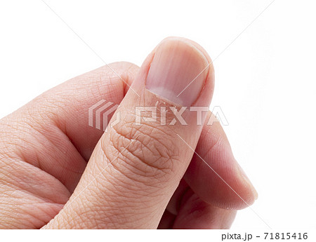 指のささくれ 71815416