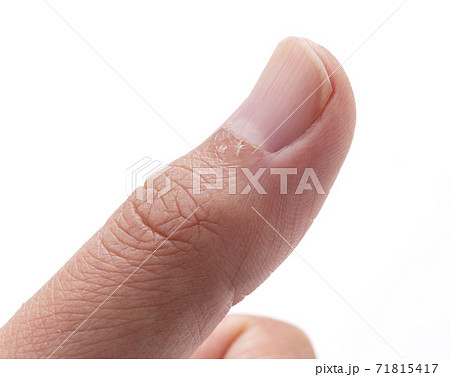 指のささくれ 指のささくれ 71815417
