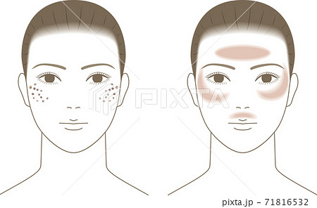 シミのある女性の顔のイラスト素材