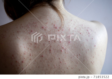 woman back with acne, red spots, skin disease woman back with acne, red spots, skin disease 71853522
