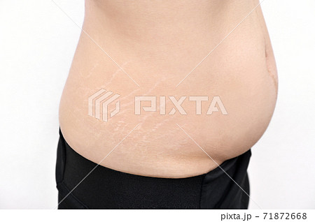 妊娠線 71872668