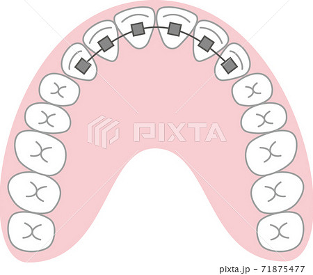 歯列矯正 歯列矯正 71875477