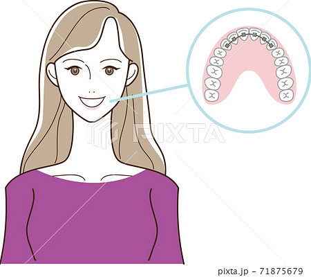 歯列矯正と女性のイラストのイラスト素材