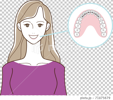 歯列矯正と女性のイラスト 歯列矯正と女性のイラスト 71875679