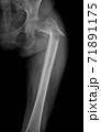 X-ray image of the right femur fracture in elderly women is the most common position in a fall accident. 71891175