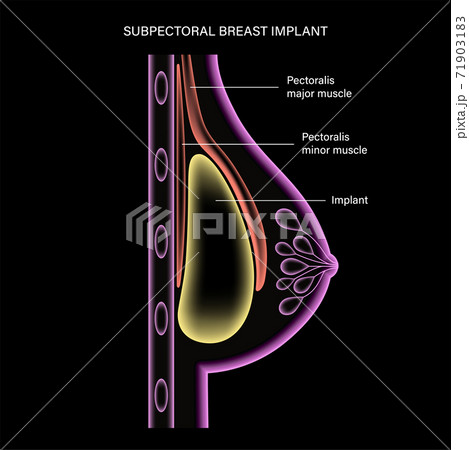 Breast Implant Concept Breast Implant Concept 71903183