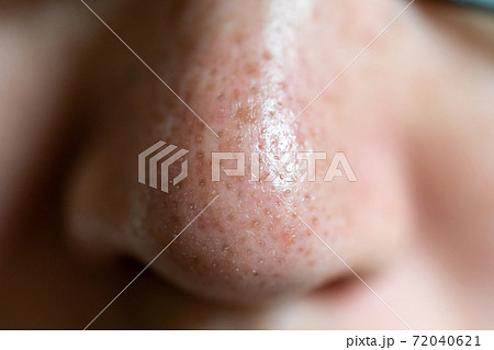 鼻の毛穴 72040621