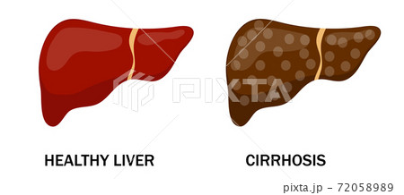 Illustration of healthy and diseased liver. Cirrhosis. Isolated art on white background. Vector. Cartoon. Flat. 72058989