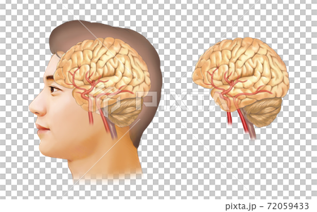 Cerebral aneurysm anatomy 72059433
