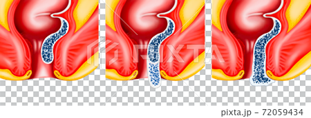 Anatomy of the hemorrhoid process 72059434