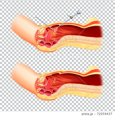 Laparoscopic surgery anatomy 72059437