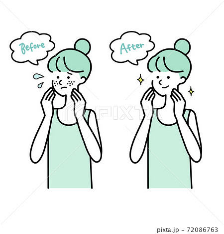 肌トラブルビフォーアフター女性イラスト 肌トラブルビフォーアフター女性イラスト 72086763