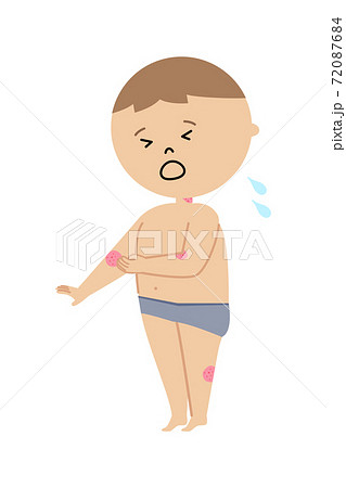 体の湿疹をかゆがる男の子のイラストのイラスト素材 72087684 Pixta