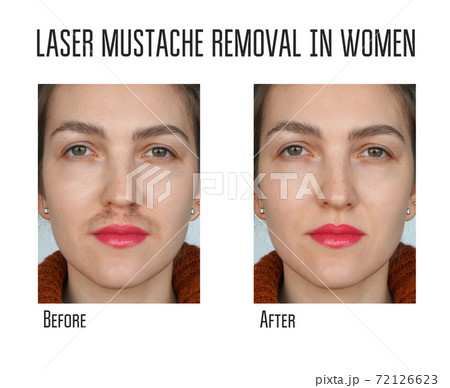 Wax, laser hair removal of the mustache for... - Stock Photo [72126623] -  PIXTA