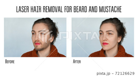 laser hair removal for beard and mustache 72126629