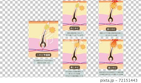 痤瘡圖的類型 痤瘡圖的類型 72151443