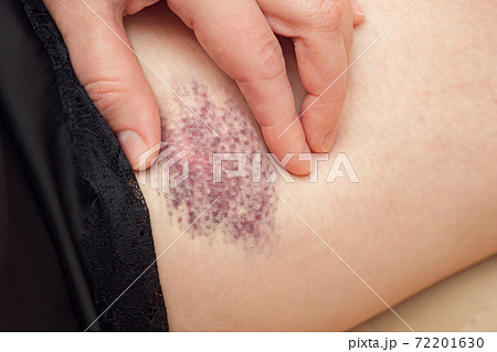 Young woman in black nightie with lace touches large bruise 72201630